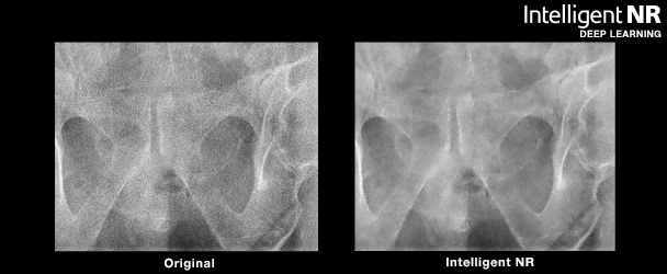 Smart Bone Suppression  